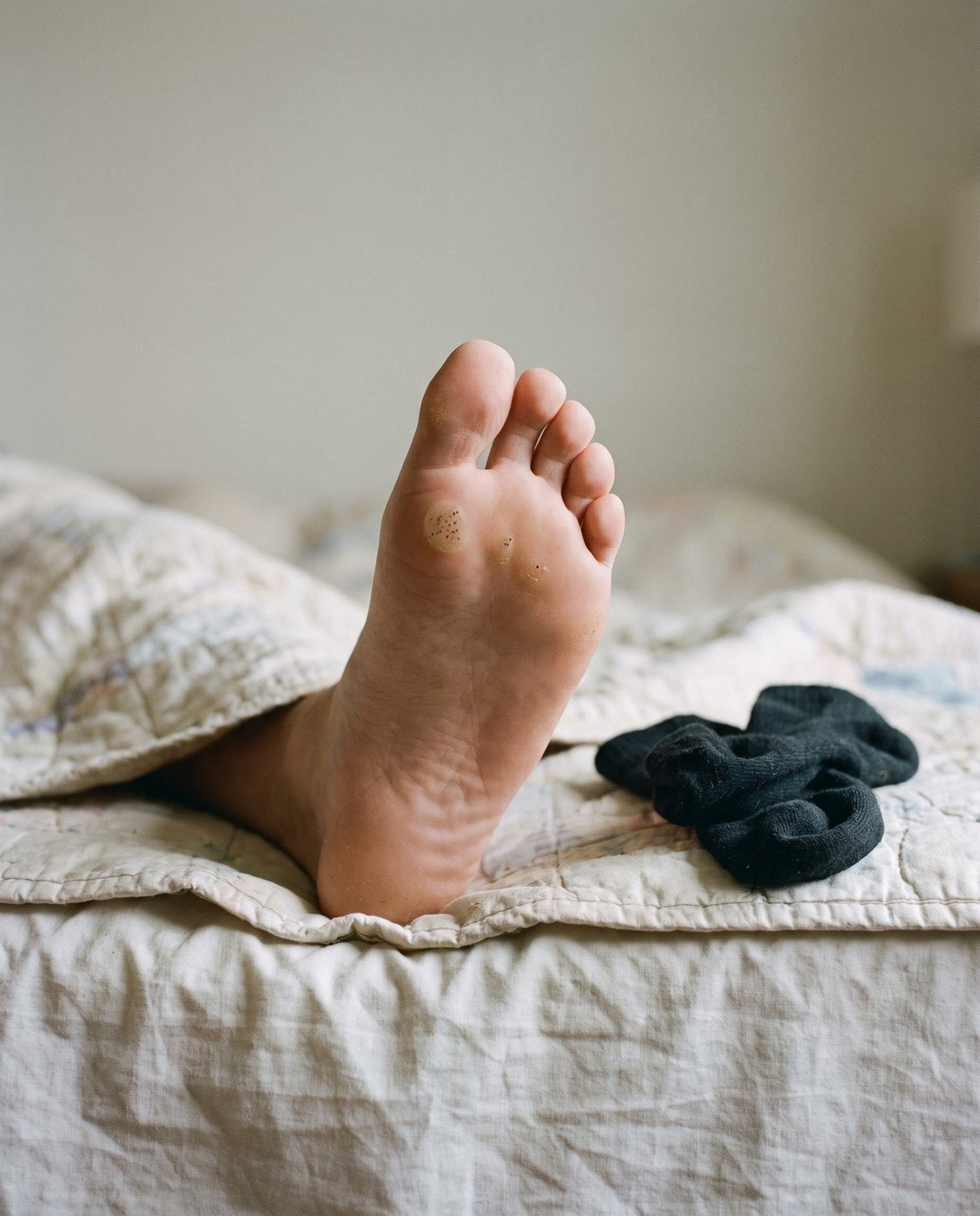The sole of a bare foot with one rough round spot and two smaller ones beside it