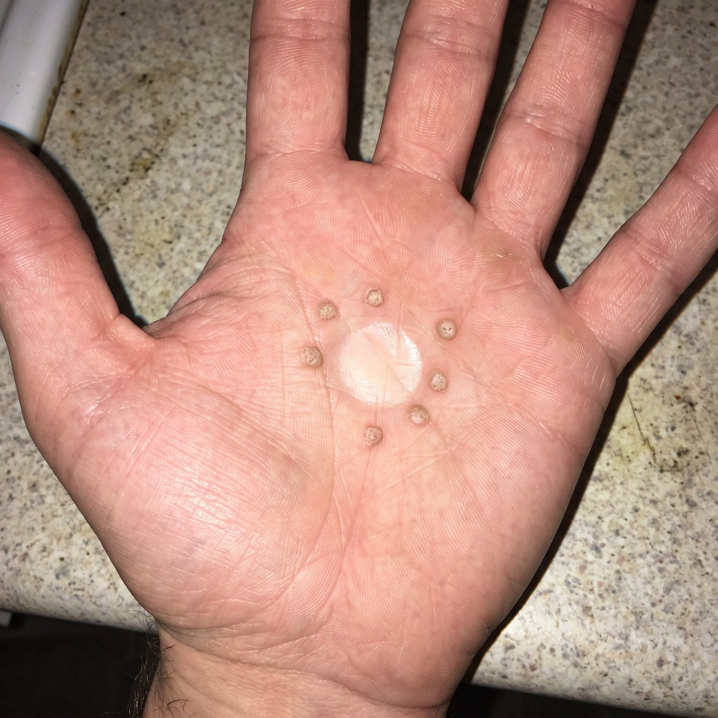 An open palm with one pale healed spot and a ring of small new warts around it